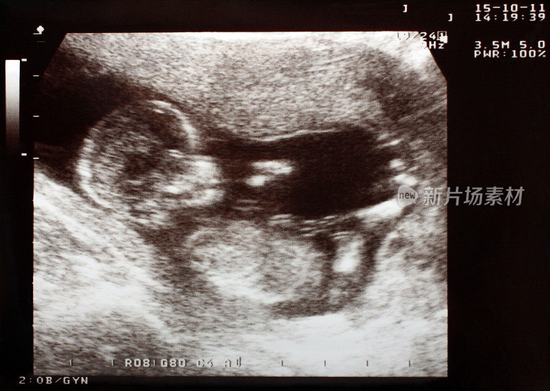 Baby Ultrasound Scan